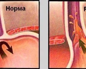 Гэрб гастрит занятия спортом